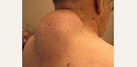 Липома. Причины, симптомы, признаки, диагностика и лечение патологии