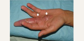 Тендовагинит. Причины, симптомы, виды, лечение и реабилитация