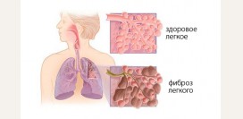 Пневмосклероз. Причины, симптомы, признаки, диагностика и лечение патологии