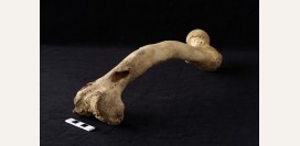 Остеомиелит. Причины, симптомы, признаки, диагностика и лечение