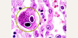 Цитомегаловирус у детей, у женщин при беременности. Результаты анализов и обнаружение антител. Симптомы и лечение цитомегаловирусной инфекции