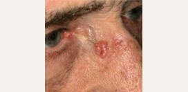 Базалиома. Причины, симптомы, признаки, диагностика и лечение патологии