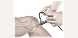 Артроскопия. Артроскопия коленного, плечевого суставов.  Показания, противопоказания, преимущества метода и реабилитация.