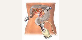 Лапароскопия желчного пузыря. Диагностическая лапароскопия желчного, удаление желчного пузыря методом лапароскопии.  Показания, противопоказания, преимущества метода и реабилитация