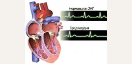 Брадикардия - причины, симптомы, признаки, диагностика и лечение патологии