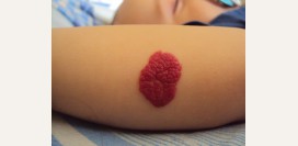 Гемангиома. Причины, симптомы, признаки, диагностика и лечение патологии