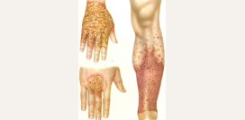 Экзема. Причины, симптомы, признаки, диагностика и лечение патологии