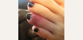 Перелом пальца ноги. Причины, симптомы, виды, первая медицинская помощь и реабилитация