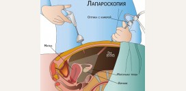 Лапароскопия маточных труб при бесплодии. Диагностическая лапароскопия маточных труб, показания, противопоказания