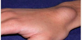 Гигрома. Причины, симптомы, виды, лечение и реабилитация