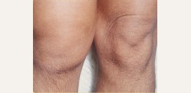 Синовит. Причины, симптомы, виды, лечение и реабилитация