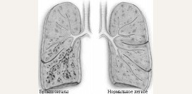 Бронхоэктатическая болезнь (бронхоэктазы). Причины, симптомы, признаки, диагностика и лечение патологии