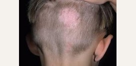 Микроспория. Причины, симптомы, признаки, диагностика и лечение патологии