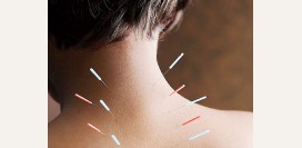 Иглоукалывание. Суть методики, показания, противопоказания