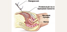 Лапароскопия матки при бесплодии. Диагностическая лапароскопия матки, показания, противопоказания