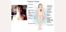 Синдром Шерешевского-Тёрнера. Причины, симптомы, признаки, диагностика и лечение патологии
