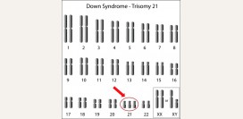 Синдром Дауна (трисомия 21). Причины, симптомы, признаки, диагностика и лечение патологии