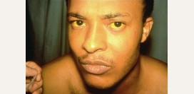 Гемолитическая анемия. Причины, симптомы, диагностика и лечение патологии