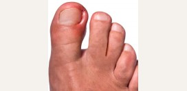 Вросший ноготь. Причины, симптомы, операция удаления ногтя и реабилитация.