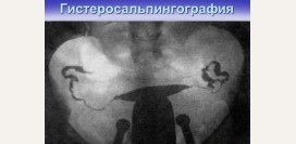 Гистеросальпингография. Диагностическая гистеросальпингография при бесплодии, показания, противопоказания