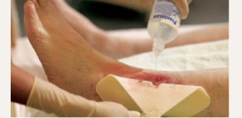 Трофические язвы. Причины, симптомы, признаки, диагностика и лечение патологии.