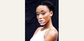 Витилиго - причины, симптомы, признаки, диагностика и лечение патологии