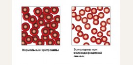 Железодефицитная анемия. Причины, симптомы, диагностика и лечение патологии