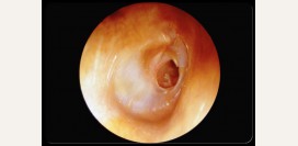 Перфорация (разрыв) барабанной перепонки. Лопнула барабанная перепонка - причины, симптомы, признаки, диагностика и лечение патологии