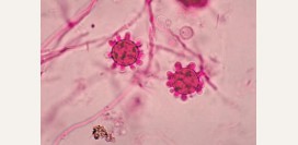 Гистоплазмоз. Причины, симптомы, диагностика и лечение патологии.