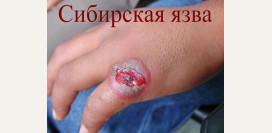 Сибирская язва. Причины, симптомы, диагностика и лечение патологии