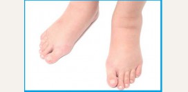 Сердечные отеки. Причины, симптомы, признаки, диагностика и лечение патологии