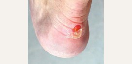 Мозоль. Причины, профилактика, лечение патологии