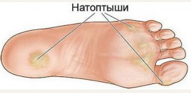Натоптыш. Причины, профилактика, лечение патологии