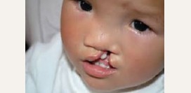 Заячья губа. Причины, симптомы, пластическая операция и реабилитация