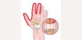 Синдром запястного канала (туннельный синдром). Причины, симптомы, признаки, диагностика и лечение патологии.