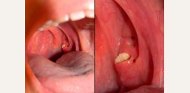 Пробки в миндалинах (в горле) - причины, симптомы, методы удаления гнойных пробок в миндалинах