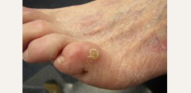 Сухая мозоль. Причины, профилактика, лечение патологии