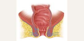 Полип прямой кишки. Причины, симптомы, диагностика, лечение и профилактика