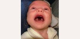 Волчья пасть. Причины, симптомы, пластическая операция и реабилитация