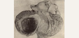 Аневризма сердца. Причины, симптомы, признаки, диагностика и лечение патологии