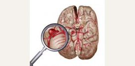 Аневризма сосудов головного мозга. Причины, симптомы, признаки, диагностика и лечение патологии