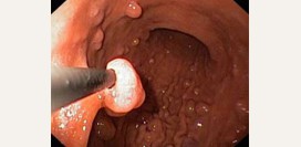 Полип желудка. Причины, симптомы, диагностика, лечение и профилактика