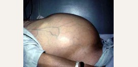 Асцит. Причины, симптомы, признаки, диагностика и лечение патологии