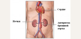 Аневризма брюшной аорты. Причины, симптомы, признаки, диагностика и лечение патологии