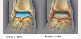 Артроз стопы (голеностопного сустава). Причины, симптомы, диагностика и лечение артроза