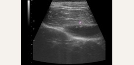 Полип желчного пузыря. Причины, симптомы, диагностика, лечение и профилактика