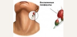 Болят (воспалены) лимфоузлы на шее. Увеличенные и болезненные шейные лимфоузлы, боль отдает в ухо, воспаленные челюстные лимфоузлы, боли при открывании рта, щелкает челюсть. Что делать при этих симптомах?