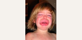 Отеки на лице. Мешки под глазами, причины и лечение