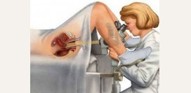 Биопсия шейки матки. Показания, противопоказания, методика. Как подготовится к биопсии и что делать после нее?