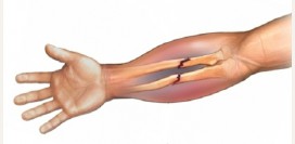 Перелом предплечья. Причины перелома, перелом со смещением, перелом лучевой кости, перелом локтевой кости